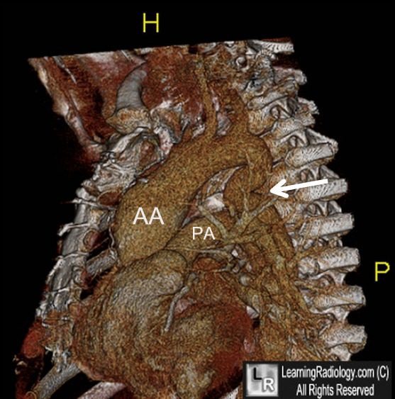 Pseudocoarctation